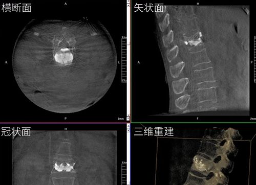 三維(wei)C形臂與二維(wei)C形臂臨牀(chuang)圖像實時對比